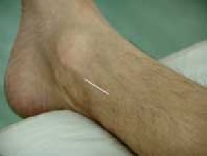 Acupuncture