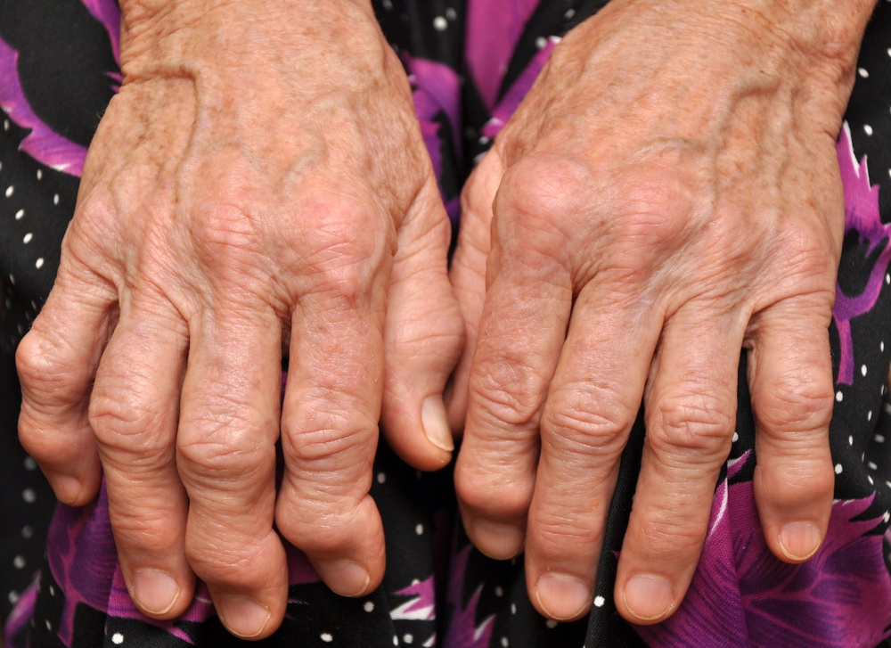 Arthritis How You Can Prevent The Worst Of It