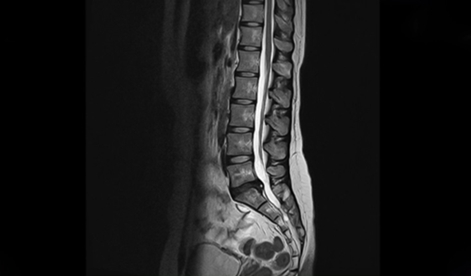 spinal-disc