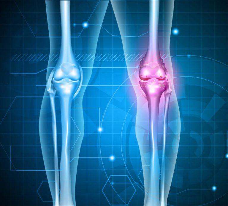 RHEUMATOID ARTHRITIS