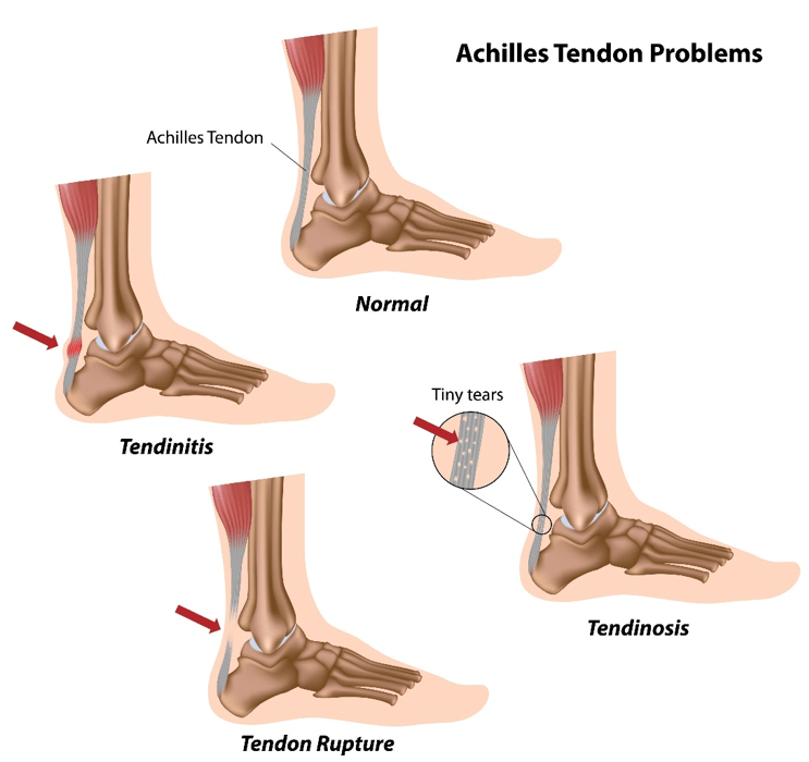 achillies-tendon-problems