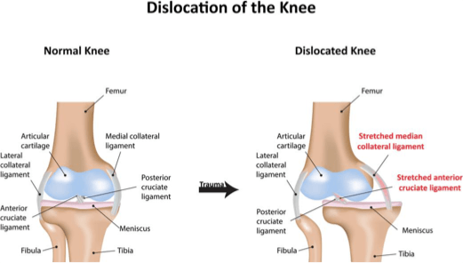 discolated-knee