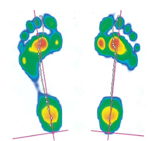 footscan plantar pressure data